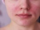 Mörkning av huden kan vara ett tecken på acanthosis nigricans